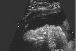孕妇超声胎儿偏小怎么回事