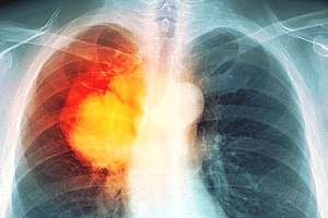肺癌有哪些征兆？